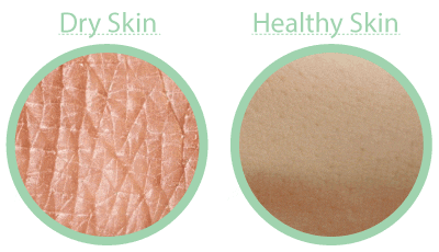 moisturize your dry skin